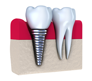 Dental Implants | Dentist in Washington, DC | Friendship Smiles